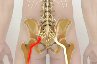 Как разблокировать седалищный нерв: 2 простых способа снять боль. А мучился-то целых 2 месяца!