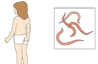 Как эффективно избавиться от глистов: никакие таблетки не сравнятся с этим средством!