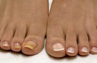 Почему Почему врачи молчат? смесь от которой исчезает грибок на ногах и руках. Мгновенный результат!