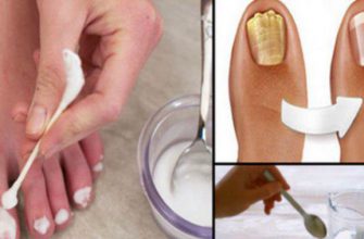 Я долго не могла удалить грибок с ногтя, пока я не сделала это. Результат меня очень порадовал!