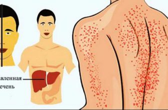 12 способов, как ваше тело пытается сказать вам, что ваша печень повреждена!