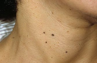 Если на шее и в подмышках есть папилломы — немедленно прекратите…