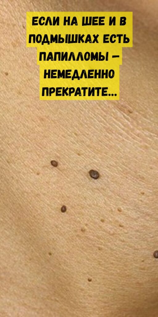 Если на шее и в подмышках есть папилломы &mdash; немедленно прекратите&hellip;