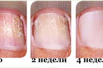 Заметили грибок на ногтях? Действуй немедленно и устрани его быстро!
