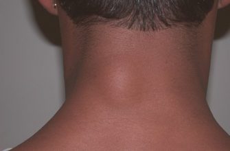 Как вывести липому (жировик)? Самый эффективный метод народной медицины