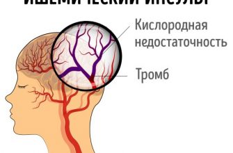 7 СИМПТОМОВ, КОТОРЫЕ ПОМОГУТ РАСПОЗНАТЬ ИНСУЛЬТ У ЖЕНЩИН