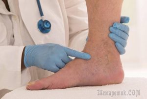 Лучшие методы лечения варикозного расширения вен на ногах