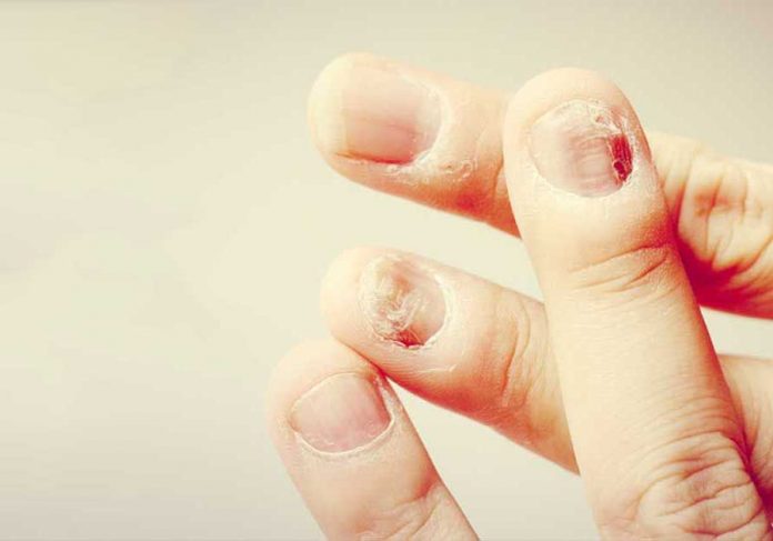 10 симптомов ногтей и то, что они означают для вашего здоровья!