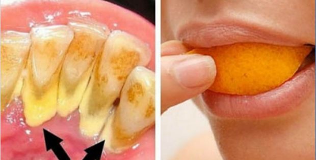 Будьте собственным стоматологом! Вот трюки, которые удалят накопление зубного камня в домашних условиях!