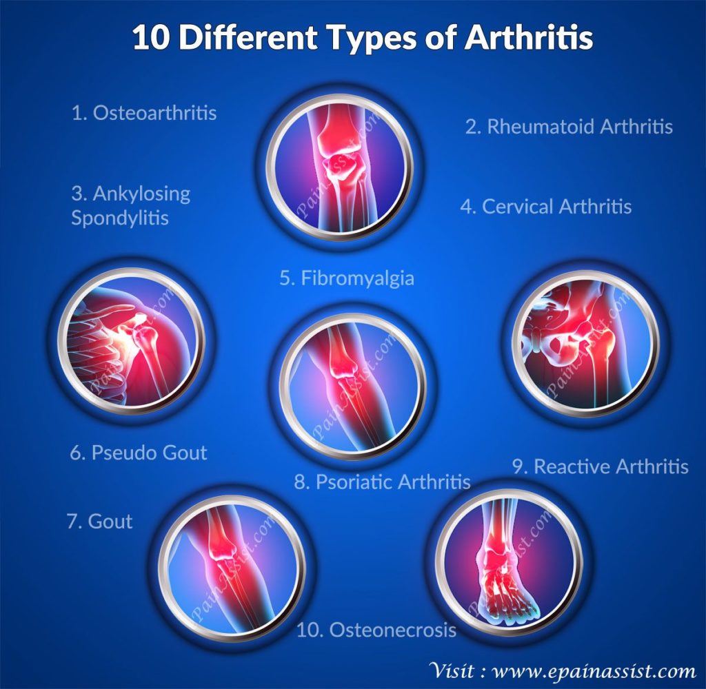 5 мифов об артрите, из-за которых становятся инвалидами