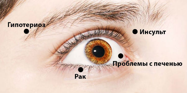 Как глаза пытаются предупредить вас о проблемах со здоровьем