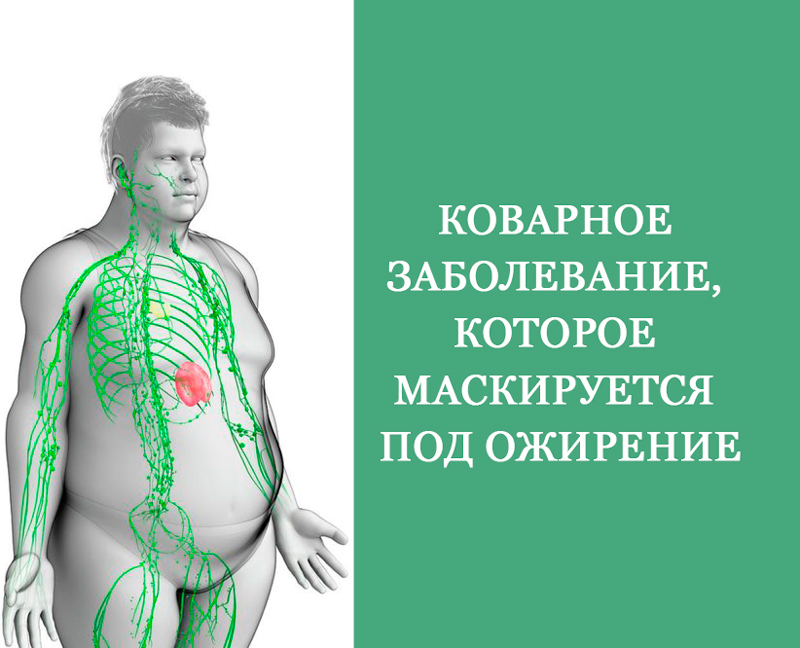 Коварное заболевание, которое маскируется под ожирение