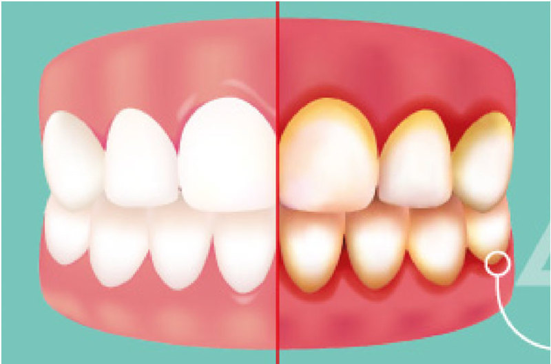 Пародонтит десен фото