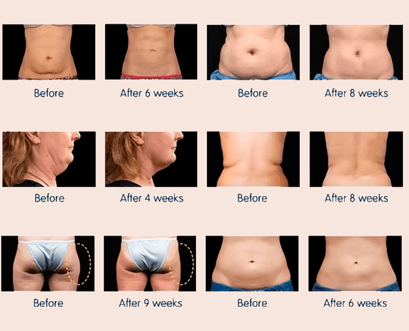 Убираем все лишнее! Надежный способ избавления от жира на животе и боках