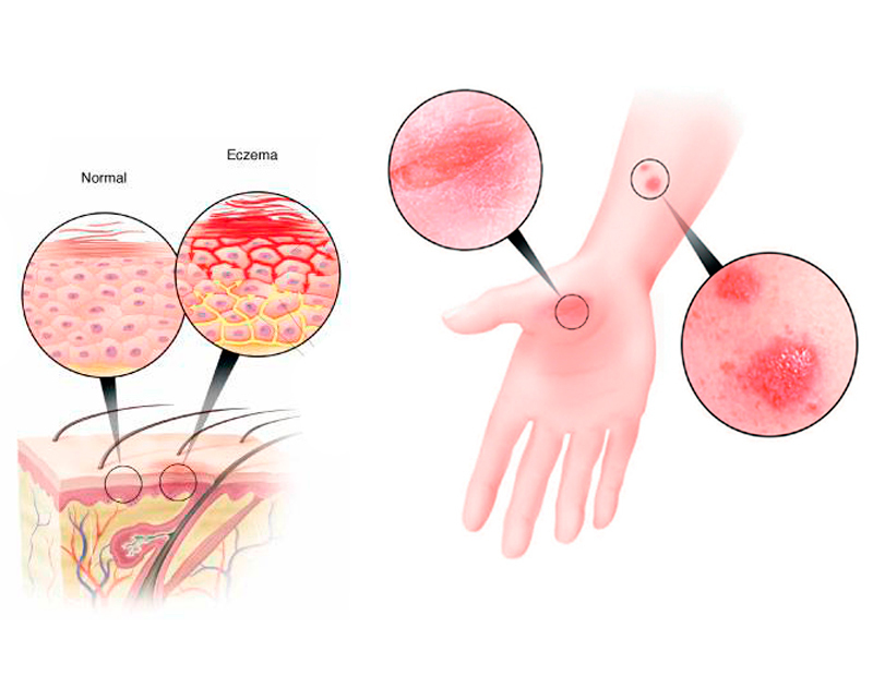 Экзема: советы дерматолога - Женский Журнал