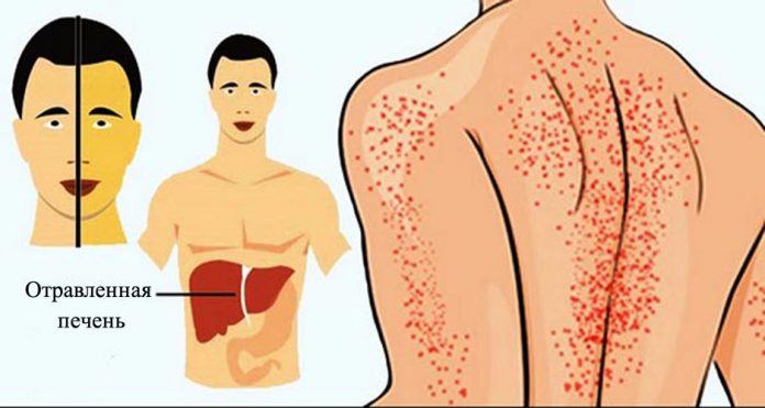 12 способов, как ваше тело пытается сказать вам, что ваша печень повреждена!