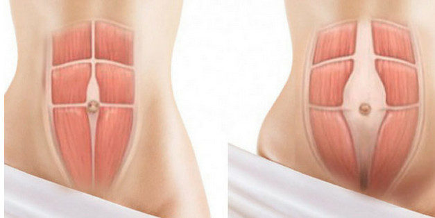 Упражнения от диастаза, от обвисания живота для женщин. Упражнения от диастаза, от обвисания живота для женщин.