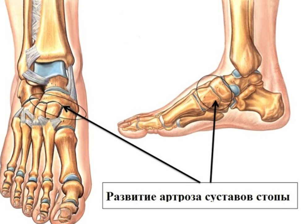 Хрустят кости ног